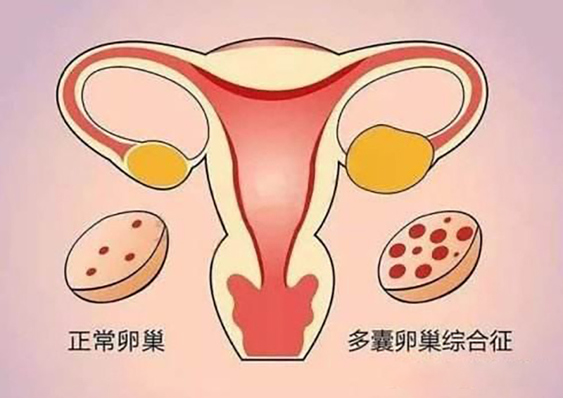 月经迟迟不来，除了怀孕,还有可能是它在作怪！